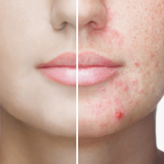 the-real-cbd-blog-cbd-til-acne