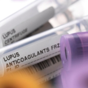 The-Real-CBD-Blog-kan-CBD-hjælpe-mod-lupus Rør til test af lupusvirus