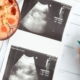 Scan billeder af nyrer med plastikmodeller af nyrer på siden