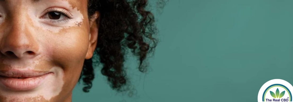 Farvet kvinde med vitiligo-pletter på huden i ansigtet