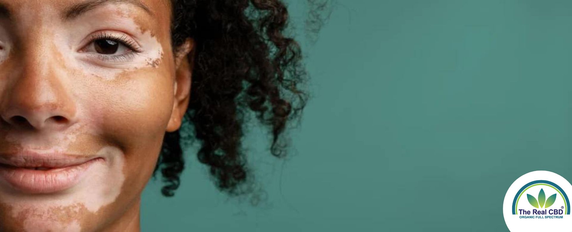 Farvet kvinde med vitiligo-pletter på huden i ansigtet