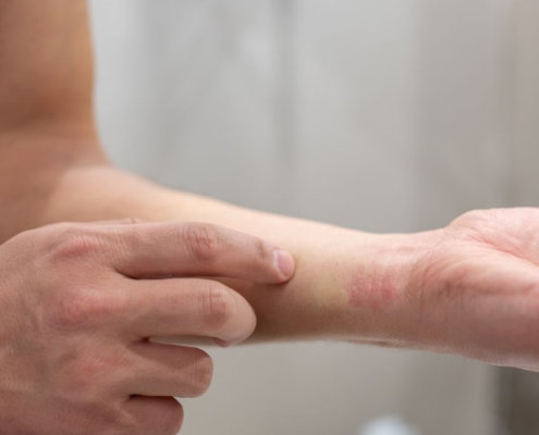 Mand med en allergisk reaktion på sit håndled