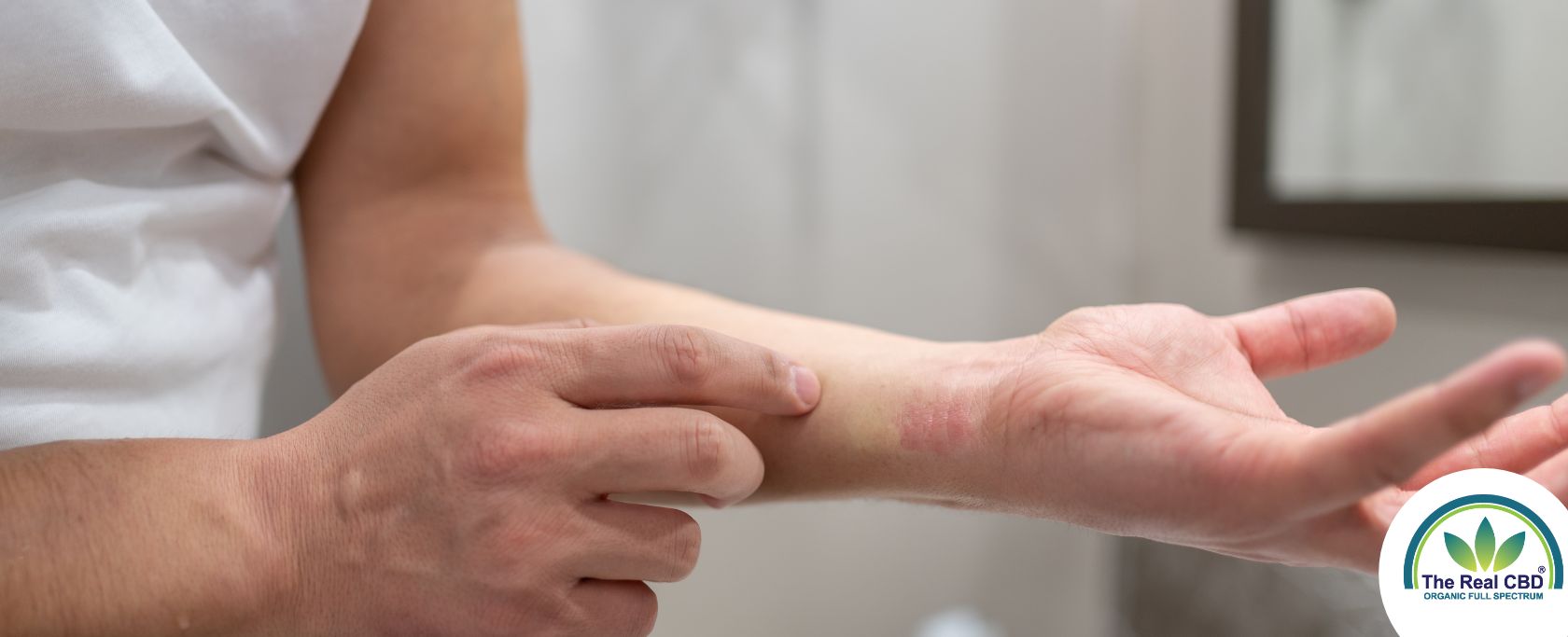 Mand med en allergisk reaktion på sit håndled