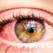 The-Real-CBD-Blog-forårsager-CBD-røde-øjne