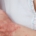 Kvinde klør sig på sin psoriasis-arm