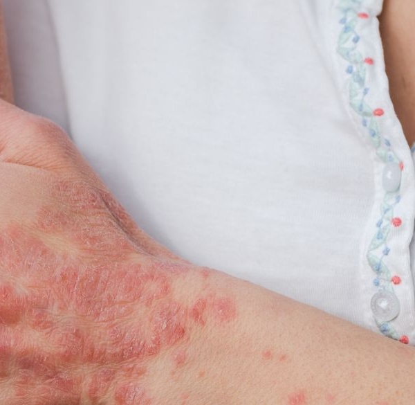 Kvinde klør sig på sin psoriasis-arm