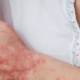 Kvinde klør sig på sin psoriasis-arm
