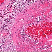 the-real-cbd-blog-CBD-til-eosinofil-granulomatose Lyserødt billede af inflammation under til microscope