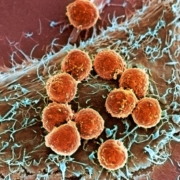 Cellule cancéreuse
