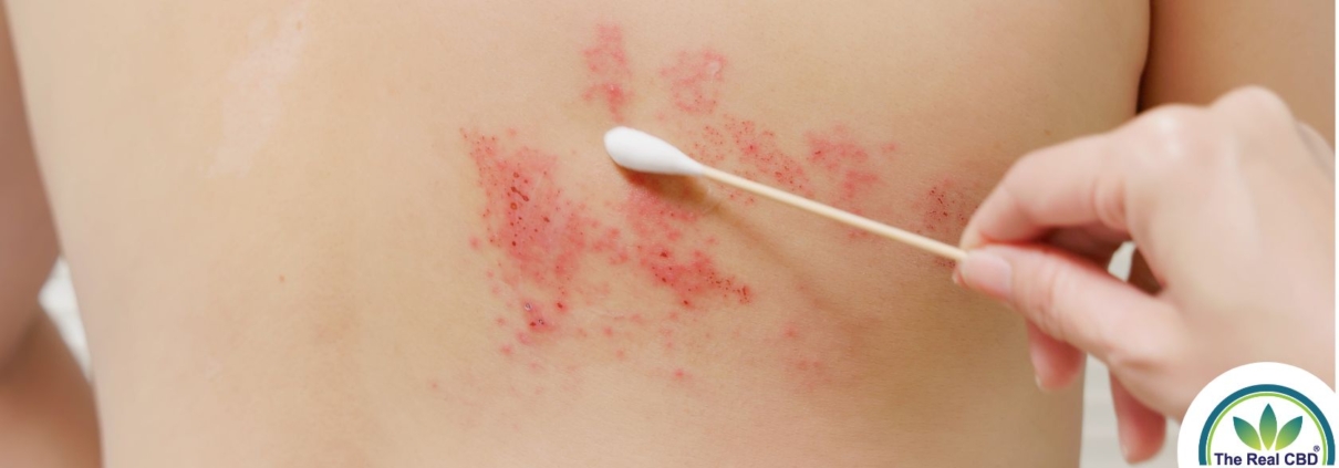 Prueba del herpes zóster con bastoncillo de algodón