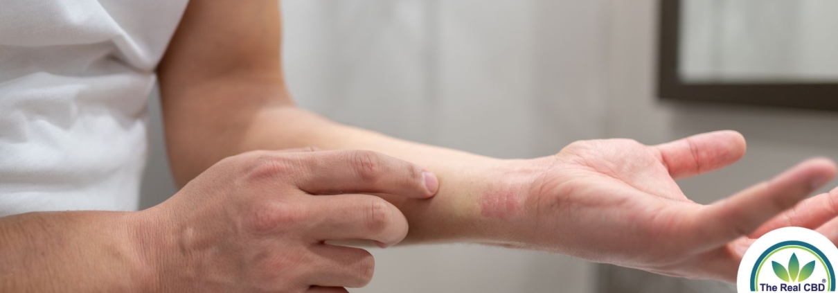 Hombre con reacción alérgica en el brazo