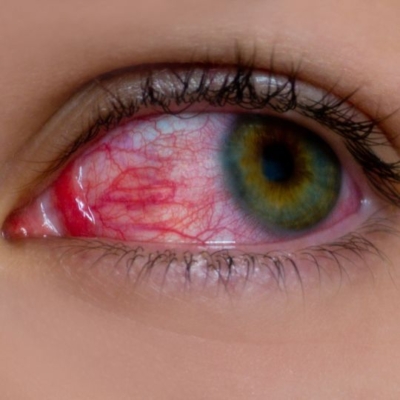 Ojos rojos de cannabis