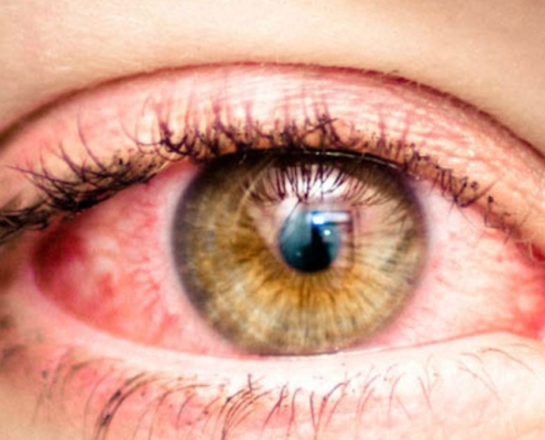 The-Real-CBD-Blog-El CBD provoca el enrojecimiento de los ojos