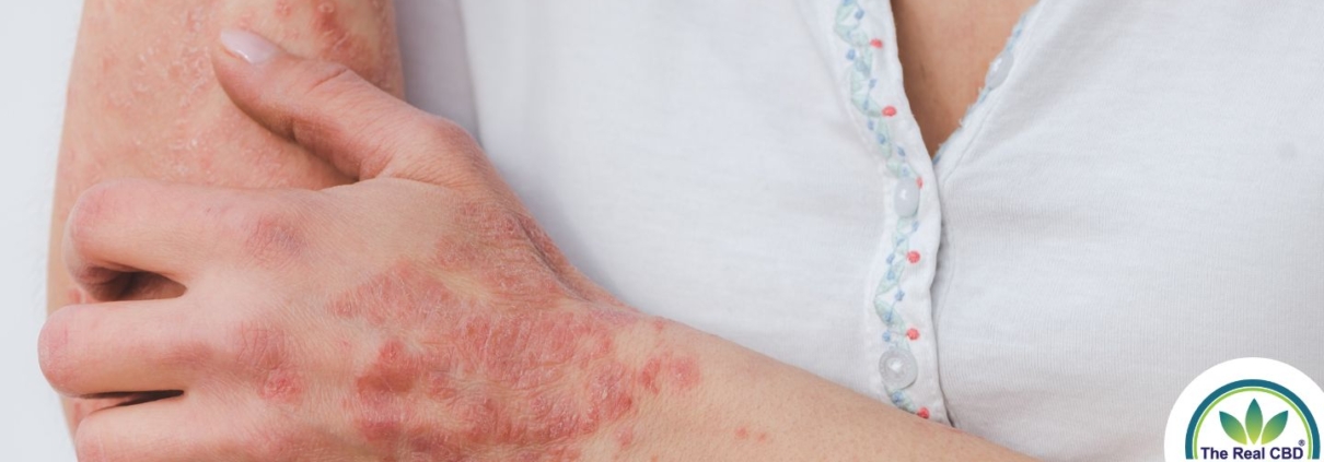 Mujer rascándose la psoriasis del brazo