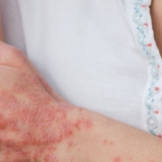 The-Real-CBD-Blog-CBD para la psoriasis Mujer rascándose la psoriasis del brazo