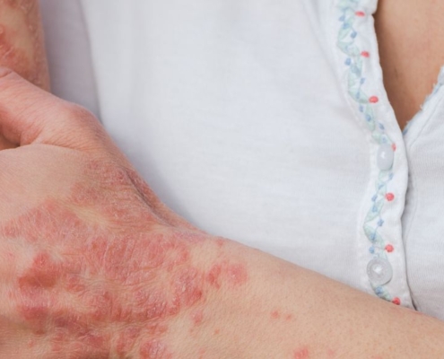 Mujer rascándose la psoriasis del brazo