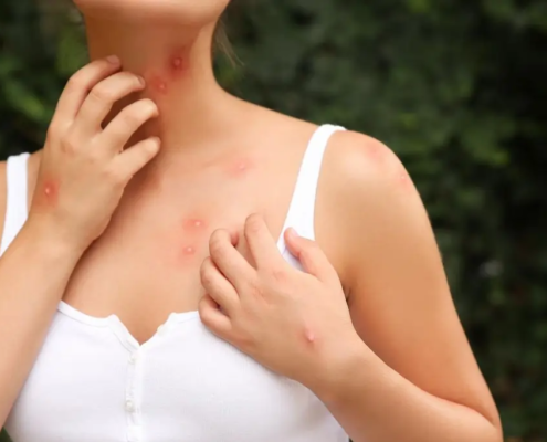 Mujer rascándose las picaduras de mosquito