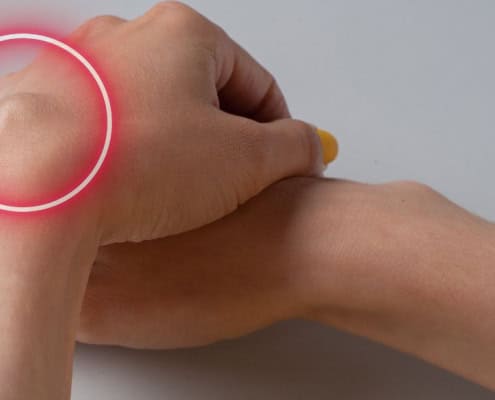 Manos cruzadas con un lipoma en la muñeca