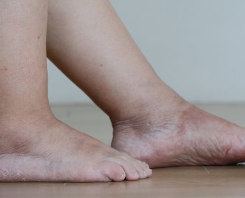 Persona con los pies hinchados