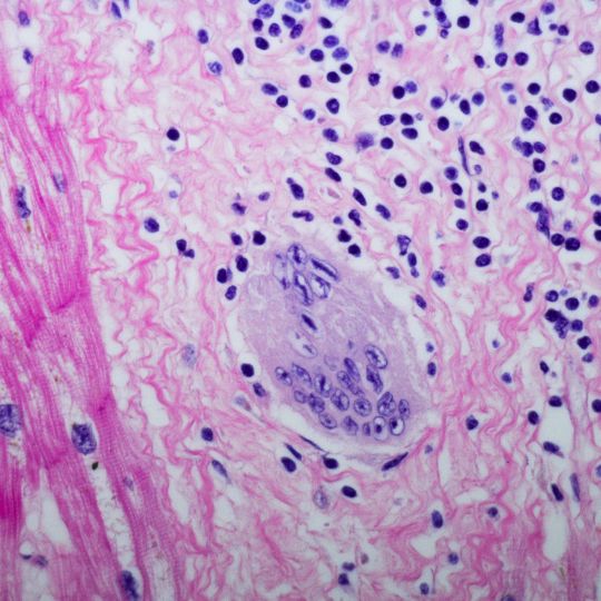 Sarcoidosis al microscopio