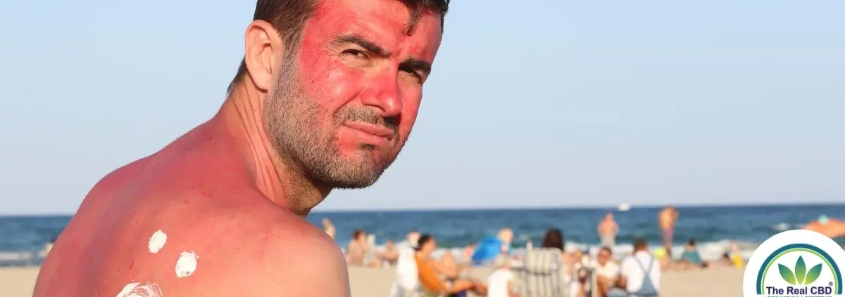 Hombre con quemaduras de sol en la playa