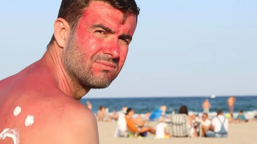Hombre con quemaduras de sol en la playa
