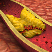 The-Real-CBD-Blog-CBD-para-la-arteriosclerosis Dibujo de una arteria obstruida