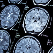 Muchas imágenes de escáneres cerebrales