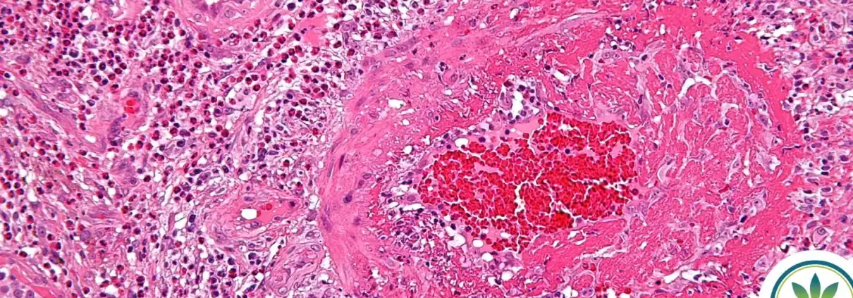Imagen rosa de la inflamación vista al microscopio