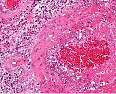 Imagen rosa de la inflamación vista al microscopio