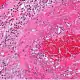 Imagen rosa de la inflamación vista al microscopio