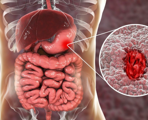 Dibujo de colitis ulcerosa