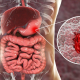 Dibujo de colitis ulcerosa