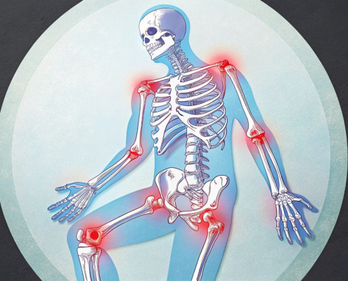 Esqueleto con dolor en las articulaciones