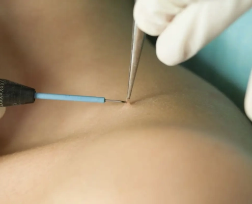 Mujer a la que le extirpan una verruga del cuello