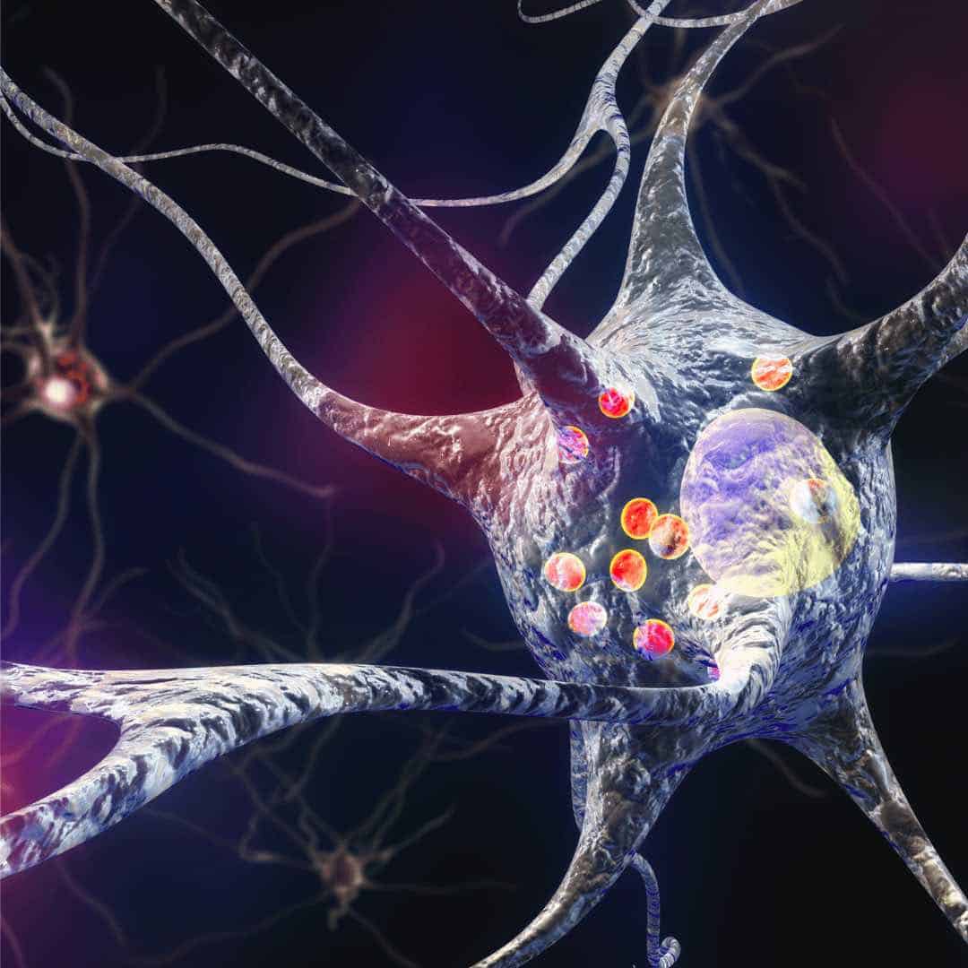 CBD bei Parkinson-Krankheit