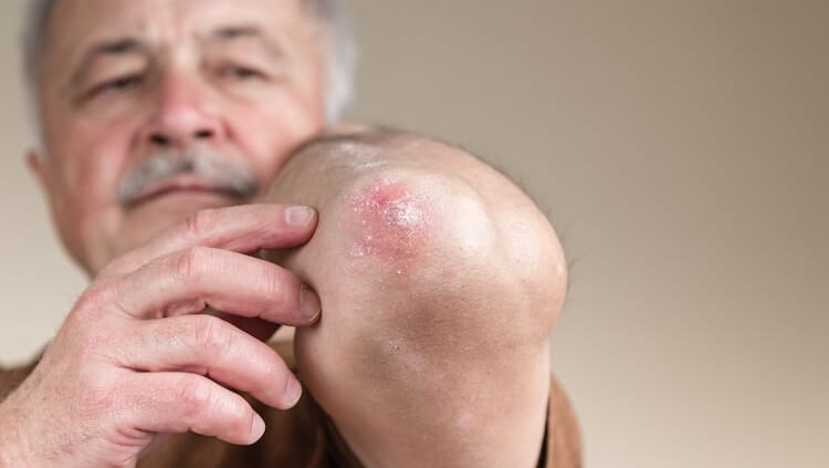 Man wijst naar zijn psoriasiselleboog