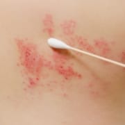 Der-Real-CBD-Blog-Kann-CBD-Helfen-Schleifen Baumwolltausch bei Ausbruch einer Gürtelrose auf der Haut des oberen Rückens