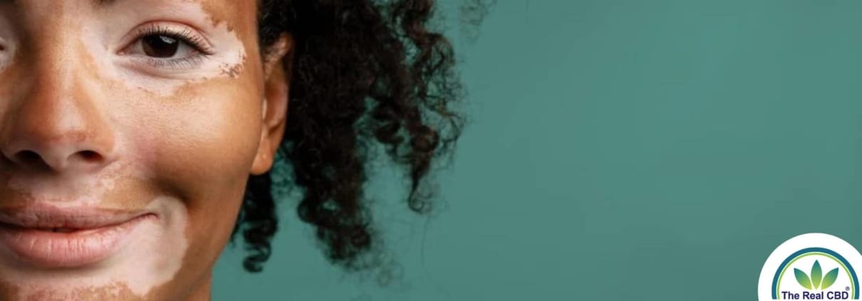 Farbige Frau mit Vitiligo-Flecken auf ihrer Haut im Gesicht