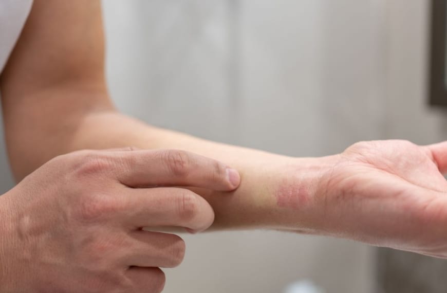 Man showing an allergic reaction on his wrist