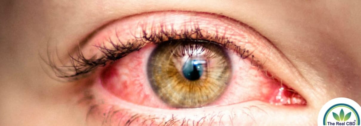 Close-up of infected eye