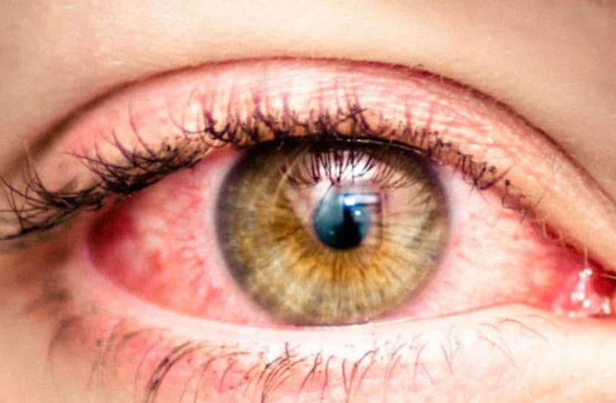 Close-up van geรฏnfecteerd oog