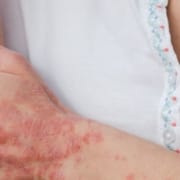 The-Real-CBD-Blog-CBD-for-psoriasis (en anglais) Femme se grattant le bras atteint de psoriasis