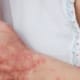 Frau kratzt sich an ihrem Psoriasis-Arm