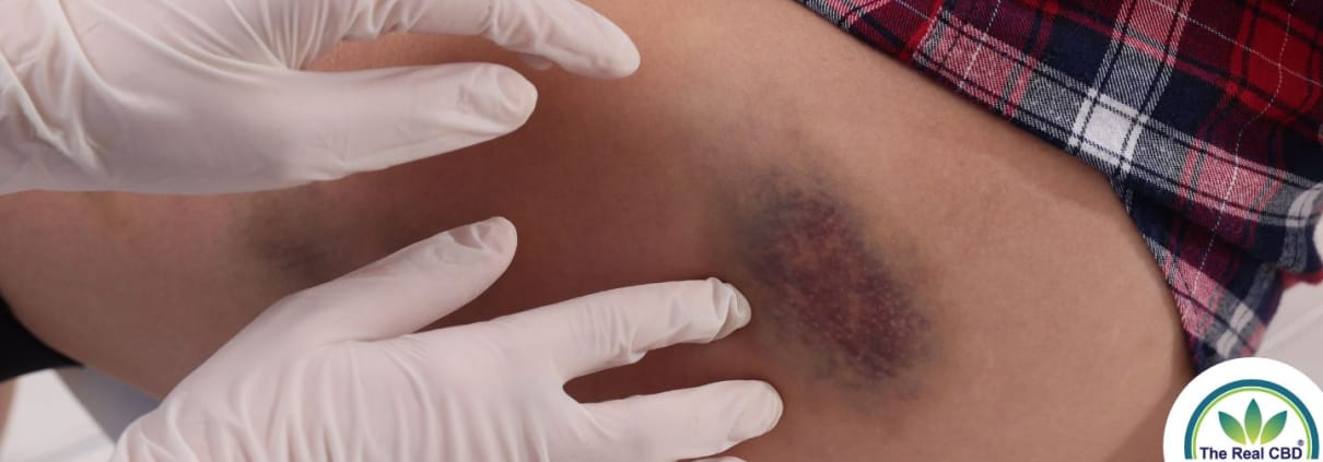 Dokters handen op grote blauwe plek op dij van vrouw