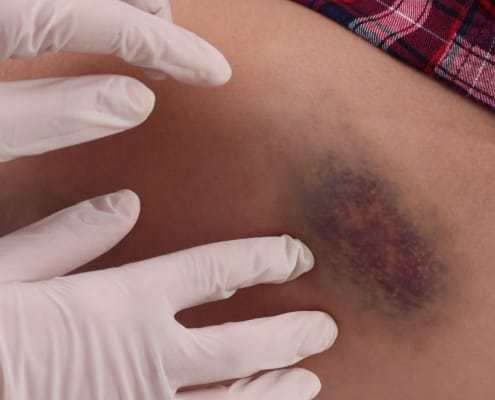 Dokters handen op grote blauwe plek op dij van vrouw