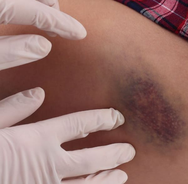 Dokters handen op grote blauwe plek op dij van vrouw