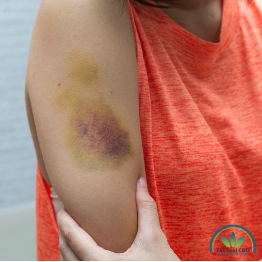 Großer violetter und gelber Bluterguss auf dem Oberarm einer Frau