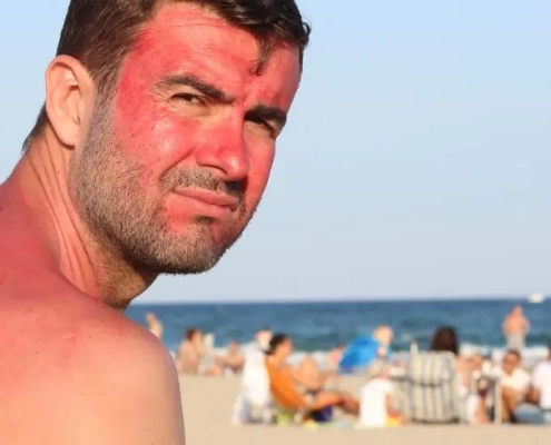 Mann sitzt am Strand mit Sonnenbrand im Gesicht und sieht unglücklich aus