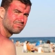 Man zittend op het strand met gezichtszonnebrand ongelukkig kijkend